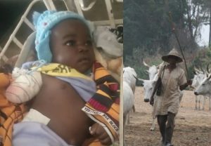 Fulani Herdmen Amputated a four months baby